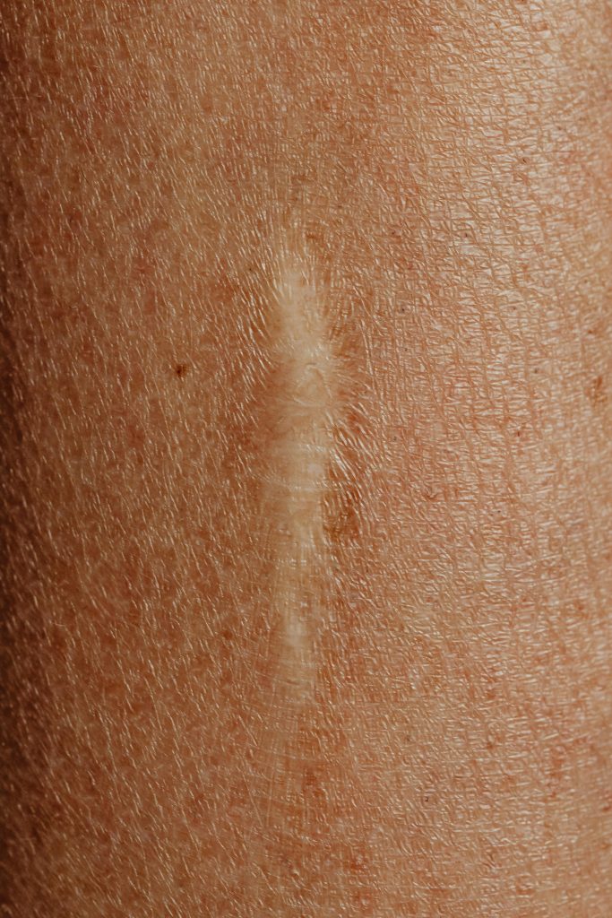Détail d'une image en gros plan d'une cicatrice cutanée, mettant en évidence la texture et le processus de guérison.