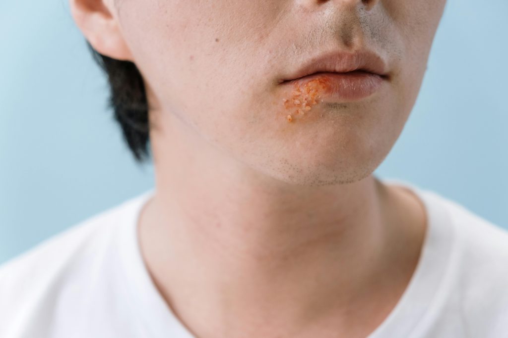 Un gros plan d'une lèvre d'une personne montrant un bouton de fièvre sur la zone de la lèvre inférieure.