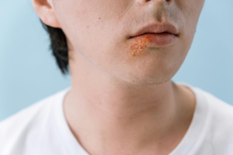 Un gros plan d'une lèvre d'une personne montrant un bouton de fièvre sur la zone de la lèvre inférieure.